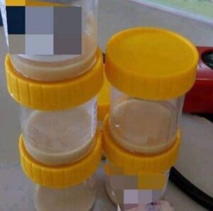 Akibat ketagih merokok, paru-paru lelaki ini penuh dengan cecair nanah
