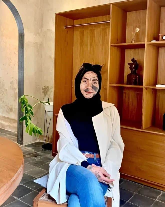 Bakal mentua 'reject', guru pun tidak sokong, ini kisah sedih gadis penuh tompok di muka. Setiap manusia dilahirkan dengan kelebihan dan kekurangan masing-masing.Andai kata kita melihat seseorang punyai kekurangan dari segi luaran atau fizikal sekalipun, ia bukanlah ‘tiket’ untuk memandang rendah apalagi menghina tuan badan.Sejak lahir sudah punyai banyak tanda lahir sekitar badan