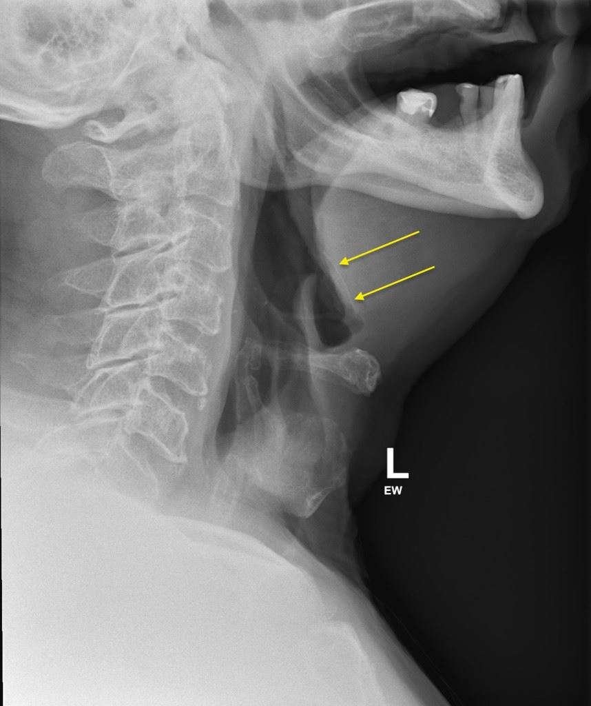 Tak perlu risau lagi jika terlekat tulang, kaedah ini berkesan, siap hancur semua tulang. Seorang wanita dari New Zealand yang tercekik tulang ayam pada lehernya, berkongsi satu kisah menarik tentang bagaimana dia berjaya mengatasi masalah tersebut.