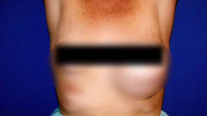 Pakar sahkan silikon dalam payudara selamatkan seorang wanita dari tembakan, peluru tersepit tidak tembus ke jantung