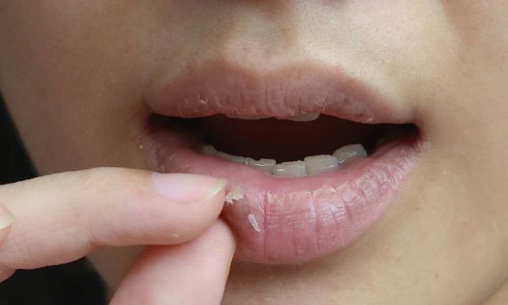 Jangan jilat bibir ketika kering, ini sebabnya