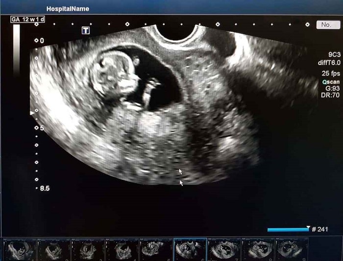 Usah kemaruk trend ini hukum kongsi janin di media sosial