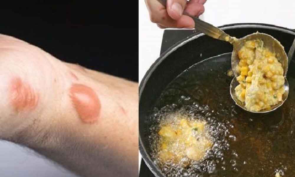 Tukang masak kongsi tip jika terkena minyak panas, hanya guna bahan ada didapur je untuk sembuh