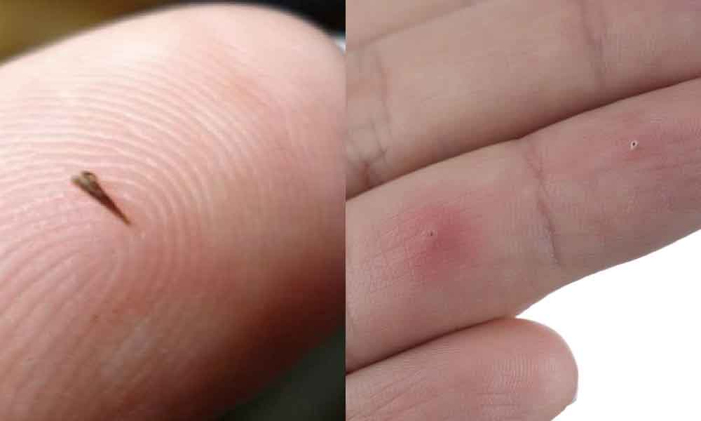 Kalau jari terkena selumbar atau duri jangan biar sampai bengkak, ini sebab ramai tak tahu