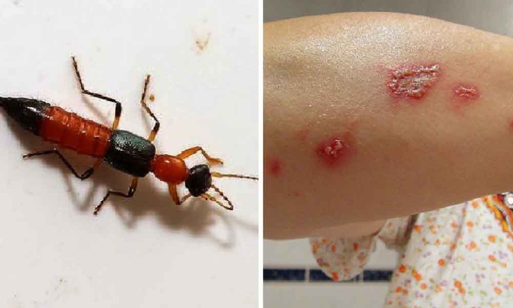 Macam semut biasa tapi kalau kena, dia punya gatal tuhan saja tahu, ini cara elak