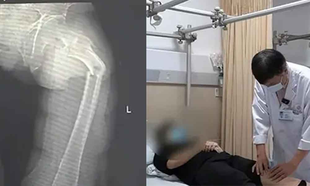 Gara-gara batuk, lelaki patah tulang paling keras dalam badan manusia