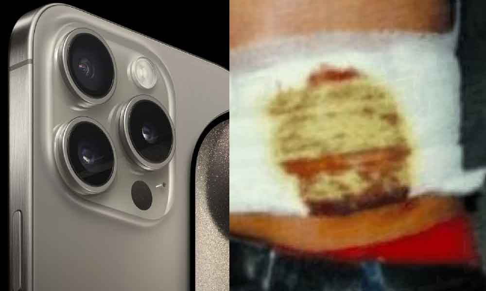 Lelaki menyesal jual buah pinggang demi iPhone, terpaksa dialisis sampai tua