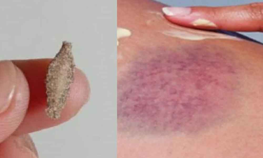 Nampak macam kuaci tapi kalau kena boleh lebam dan gatal