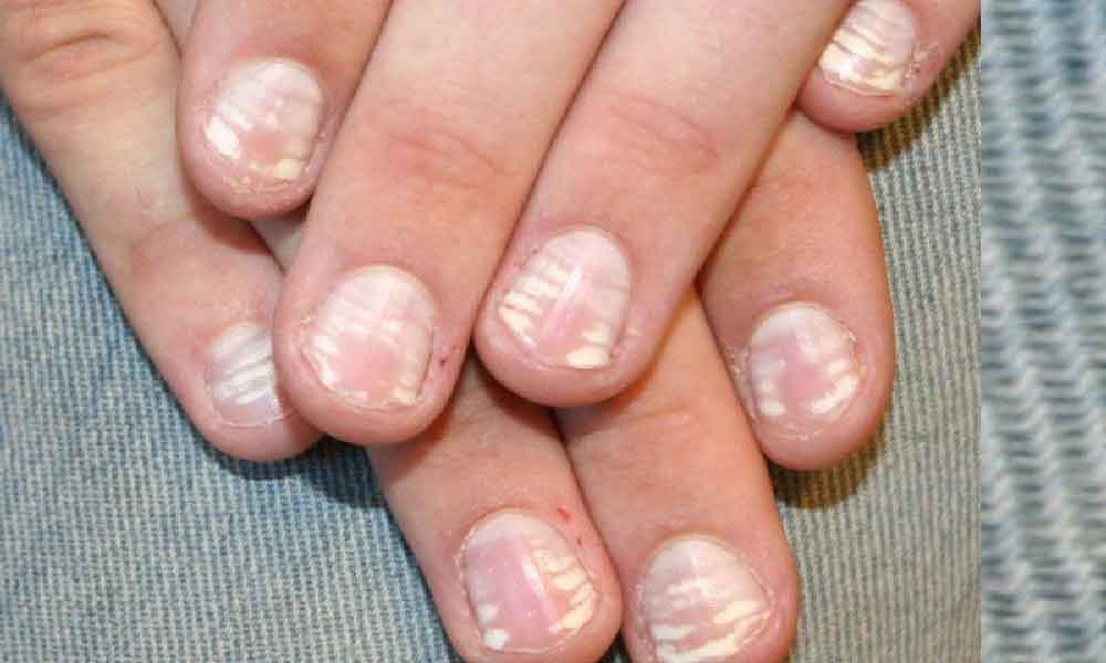 Dengan hanya tengok kuku dah boleh tahu masalah kesihatan, ini caranya