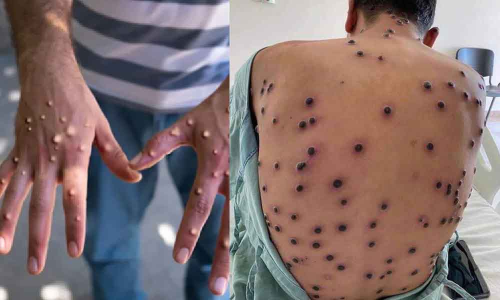 MPOX dah sampai Jakarta, ini yang rakyat Malaysia perlu tahu tentang penyakit ini