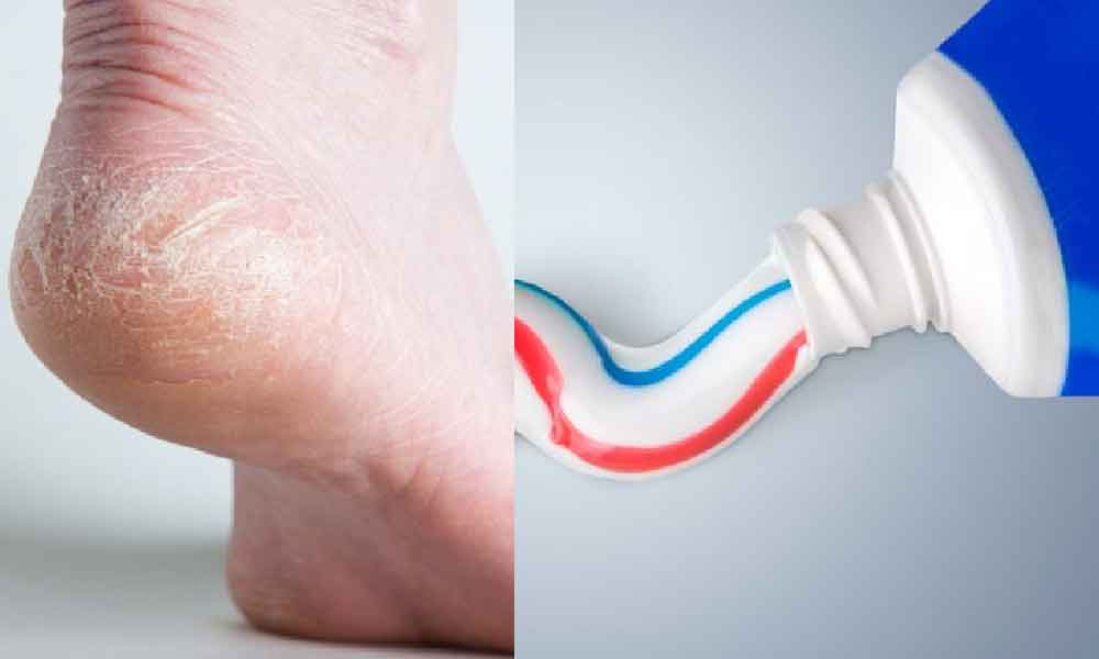Baru tahu ubat gigi boleh rawat tumit merekah, ini cara penggunaannya