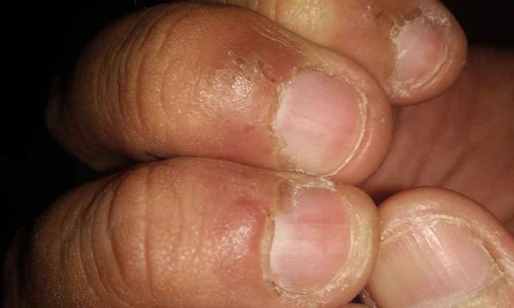 6 tanda masalah kuku berkait dengan penyakit jantung, no.3 tu 'kuku clubbing' ?