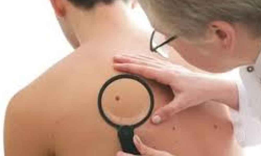 Ingatkan tak berbahaya tapi ramai tak tahu tahi lalat sebenarnya kanser!